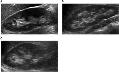 X-linked hypophosphatemic rickets and nephrocalcinosis: clinical characteristics of a single-center pediatric cohort in North America before and after burosumab